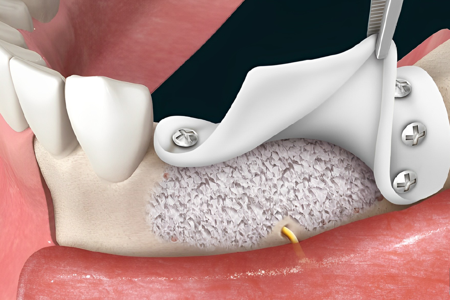 Imagem ilustrativa de uma boca com enxerto ósseo