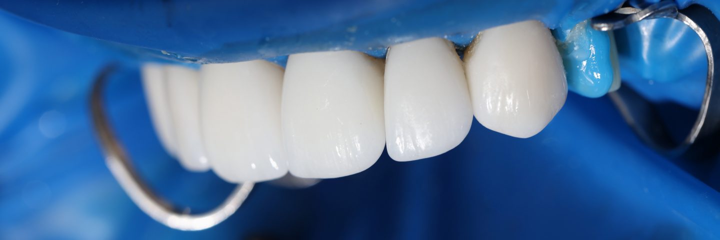 Instalação de facetas e implantes dentários.